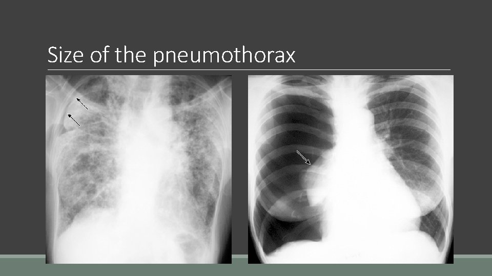 Size of the pneumothorax 