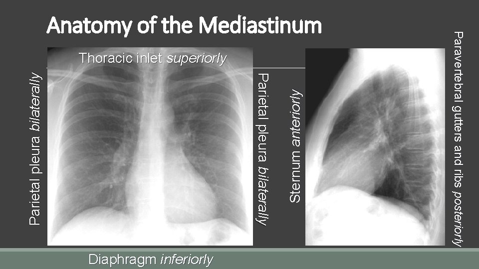 Diaphragm inferiorly Sternum anteriorly Parietal pleura bilaterally Thoracic inlet superiorly Paravertebral gutters and ribs