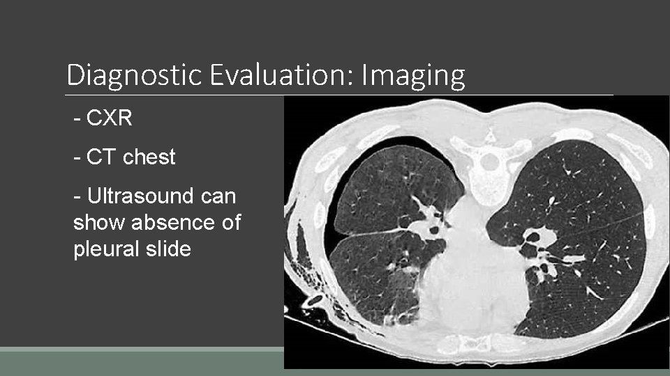 Diagnostic Evaluation: Imaging - CXR - CT chest - Ultrasound can show absence of