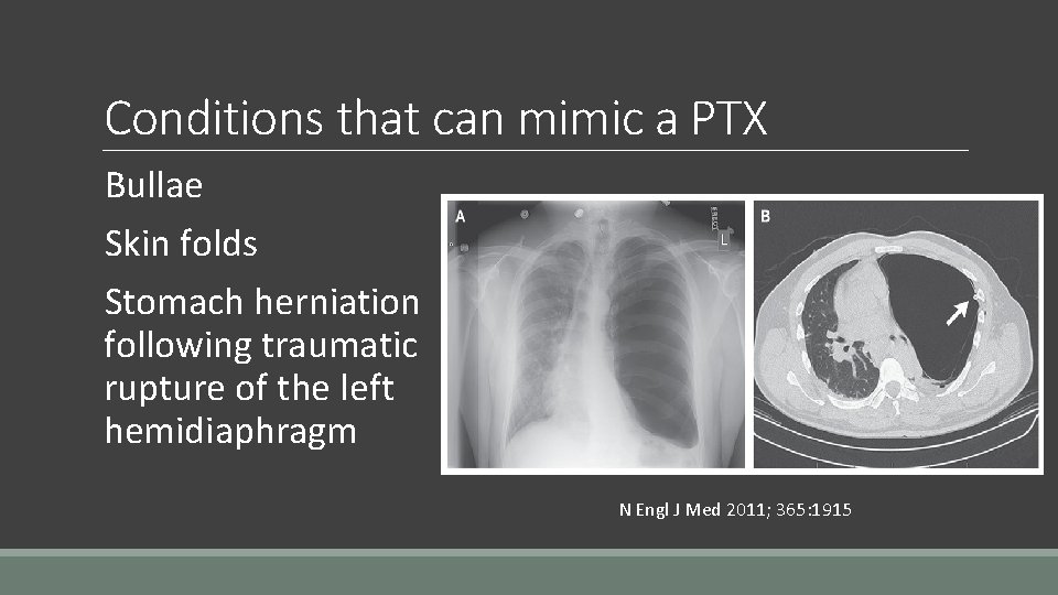 Conditions that can mimic a PTX Bullae Skin folds Stomach herniation following traumatic rupture