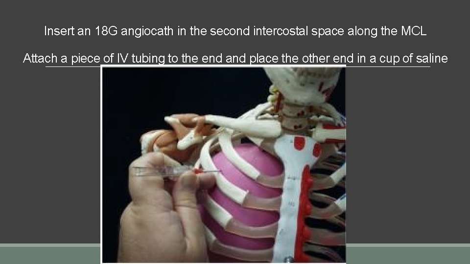 Insert an 18 G angiocath in the second intercostal space along the MCL Attach