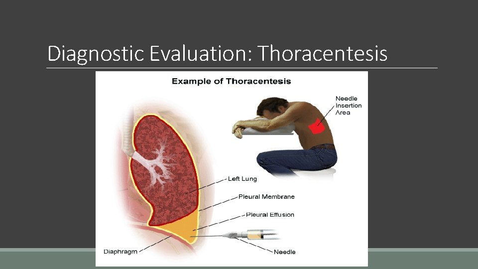 Diagnostic Evaluation: Thoracentesis 