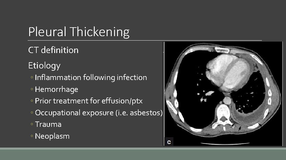 Pleural Thickening CT definition Etiology ◦ Inflammation following infection ◦ Hemorrhage ◦ Prior treatment