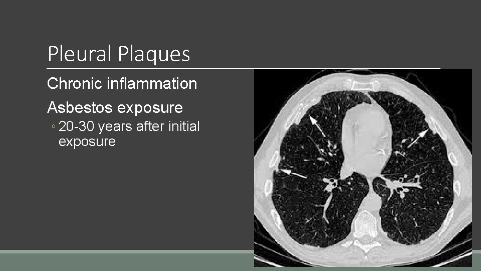 Pleural Plaques Chronic inflammation Asbestos exposure ◦ 20 -30 years after initial exposure 