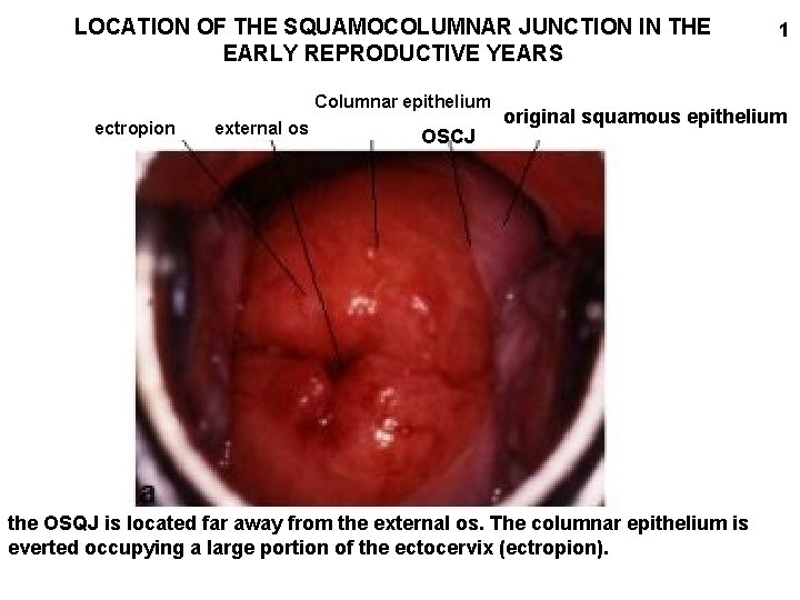 LOCATION OF THE SQUAMOCOLUMNAR JUNCTION IN THE EARLY REPRODUCTIVE YEARS Columnar epithelium ectropion external