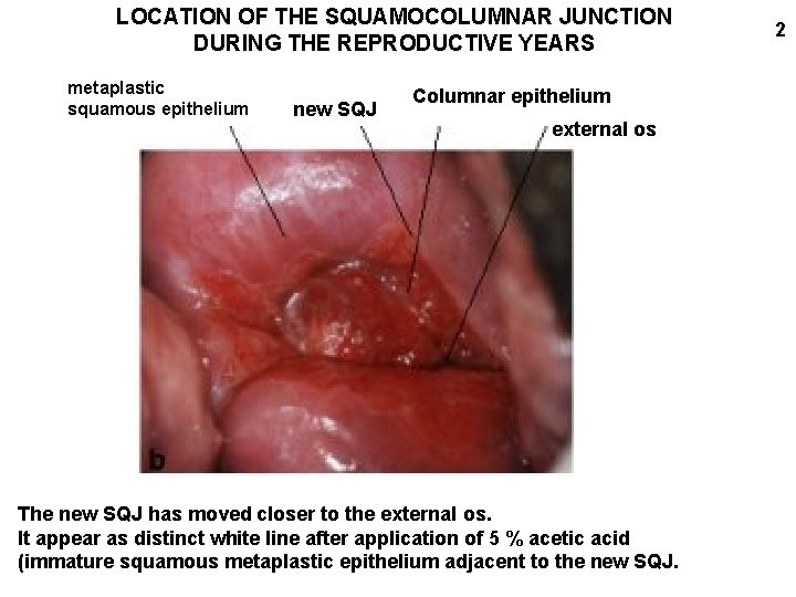 LOCATION OF THE SQUAMOCOLUMNAR JUNCTION DURING THE REPRODUCTIVE YEARS metaplastic squamous epithelium new SQJ