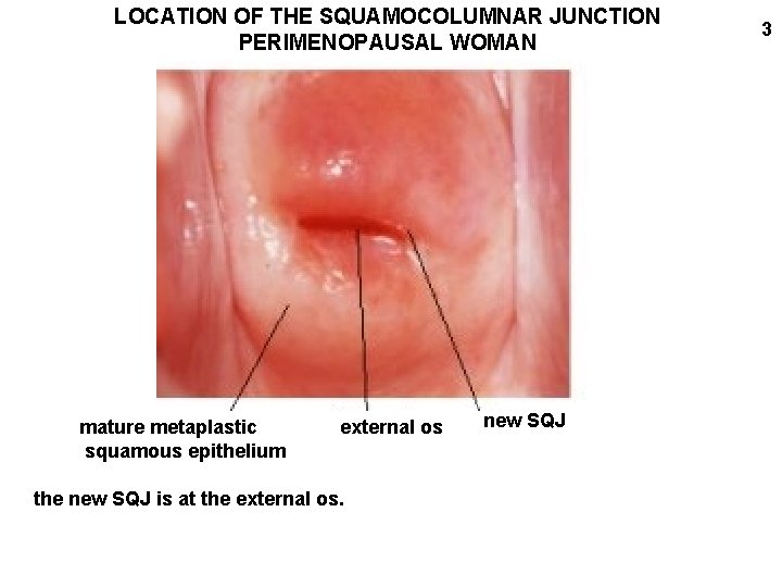 LOCATION OF THE SQUAMOCOLUMNAR JUNCTION PERIMENOPAUSAL WOMAN mature metaplastic squamous epithelium external os the