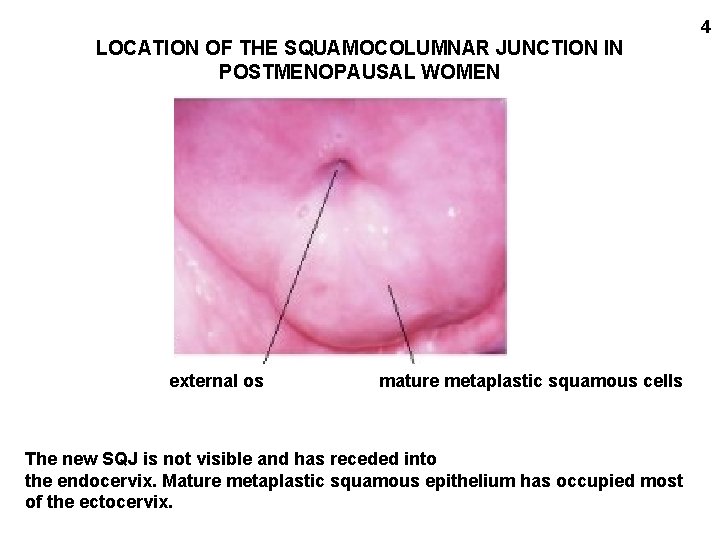 4 LOCATION OF THE SQUAMOCOLUMNAR JUNCTION IN POSTMENOPAUSAL WOMEN external os mature metaplastic squamous