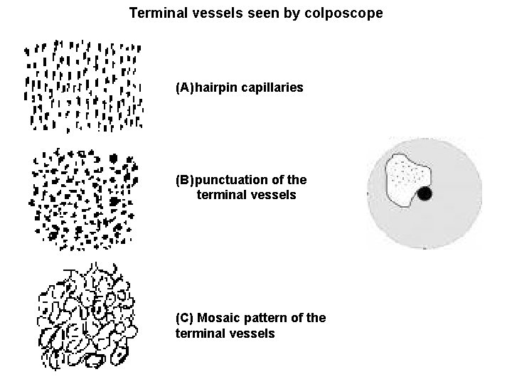 Terminal vessels seen by colposcope (A) hairpin capillaries (B) punctuation of the terminal vessels