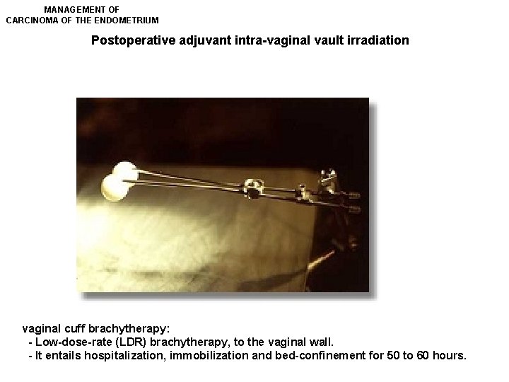 MANAGEMENT OF CARCINOMA OF THE ENDOMETRIUM Postoperative adjuvant intra-vaginal vault irradiation vaginal cuff brachytherapy: