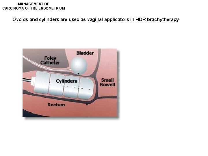 MANAGEMENT OF CARCINOMA OF THE ENDOMETRIUM Ovoids and cylinders are used as vaginal applicators