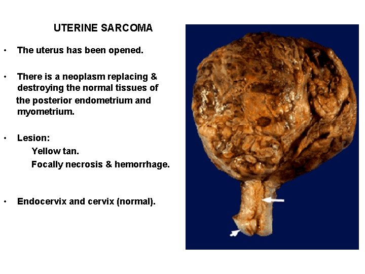 UTERINE SARCOMA • The uterus has been opened. • There is a neoplasm replacing