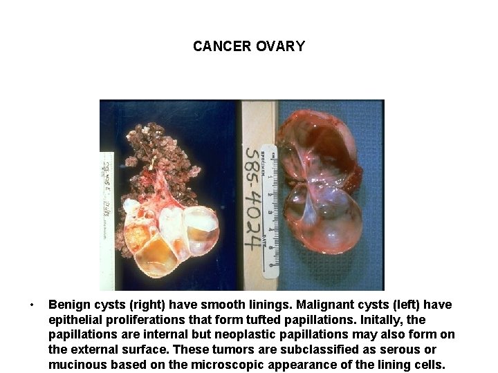 CANCER OVARY • Benign cysts (right) have smooth linings. Malignant cysts (left) have epithelial