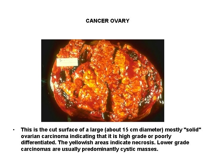 CANCER OVARY • This is the cut surface of a large (about 15 cm