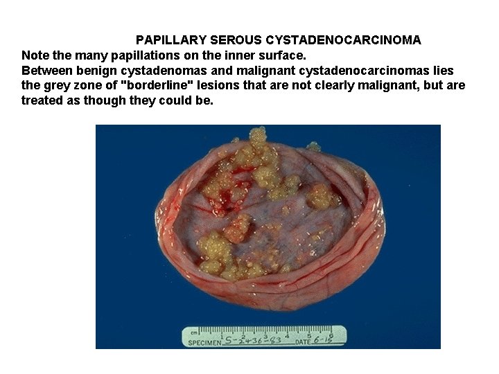 PAPILLARY SEROUS CYSTADENOCARCINOMA Note the many papillations on the inner surface. Between benign cystadenomas