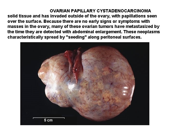 OVARIAN PAPILLARY CYSTADENOCARCINOMA solid tissue and has invaded outside of the ovary, with papillations