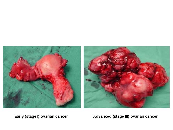 Early (stage I) ovarian cancer Advanced (stage III) ovarian cancer 