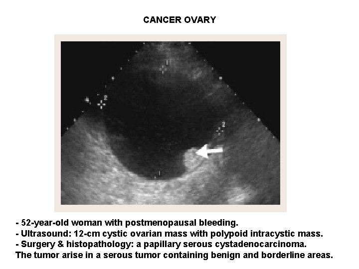 CANCER OVARY - 52 -year-old woman with postmenopausal bleeding. - Ultrasound: 12 -cm cystic