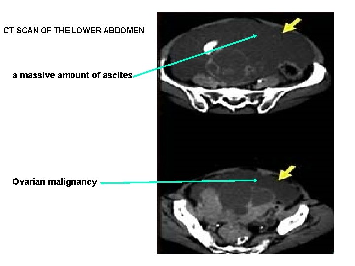 CT SCAN OF THE LOWER ABDOMEN a massive amount of ascites Ovarian malignancy 