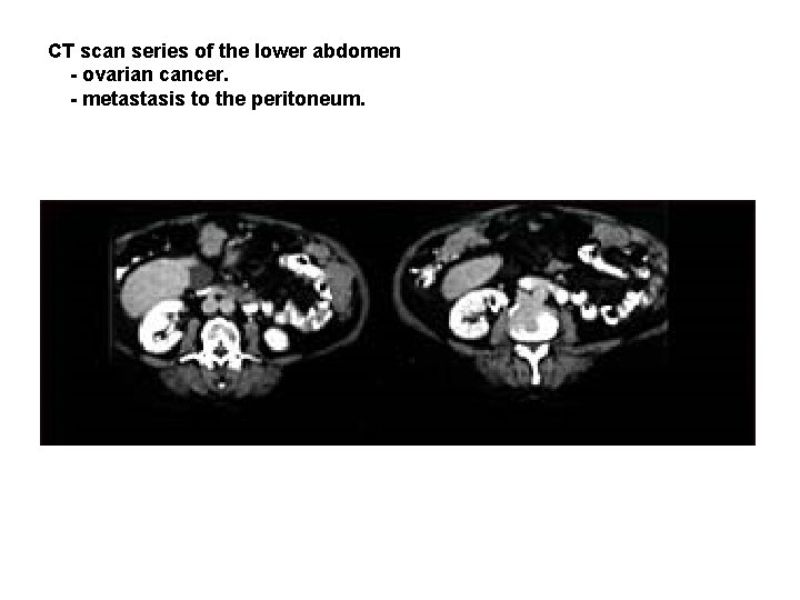 CT scan series of the lower abdomen - ovarian cancer. - metastasis to the