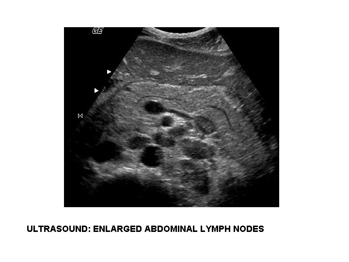 ULTRASOUND: ENLARGED ABDOMINAL LYMPH NODES 