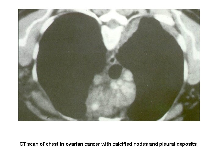 CT scan of chest in ovarian cancer with calcified nodes and pleural deposits 
