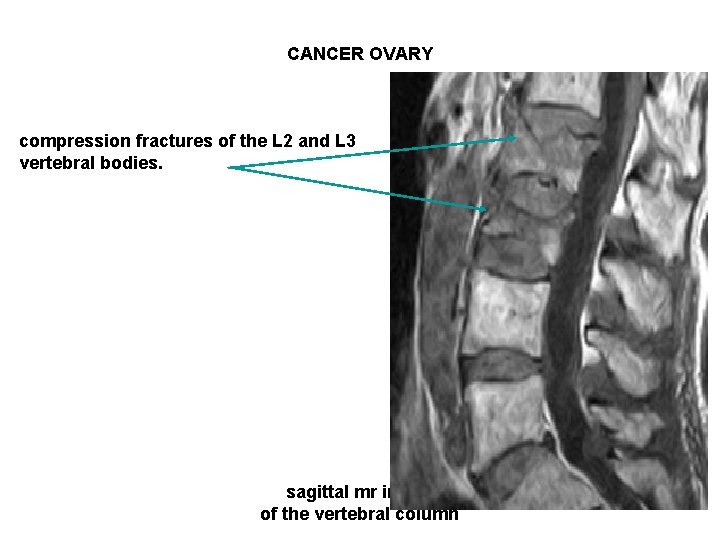 CANCER OVARY compression fractures of the L 2 and L 3 vertebral bodies. sagittal