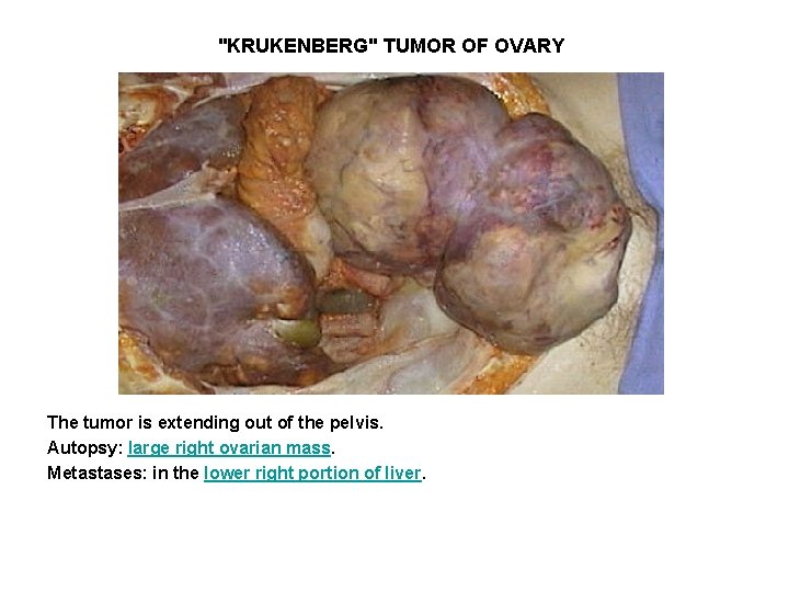 "KRUKENBERG" TUMOR OF OVARY The tumor is extending out of the pelvis. Autopsy: large