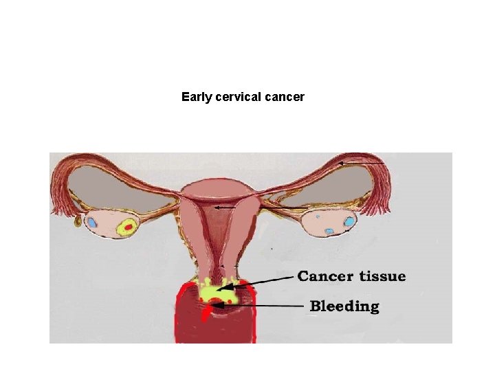 Early cervical cancer 