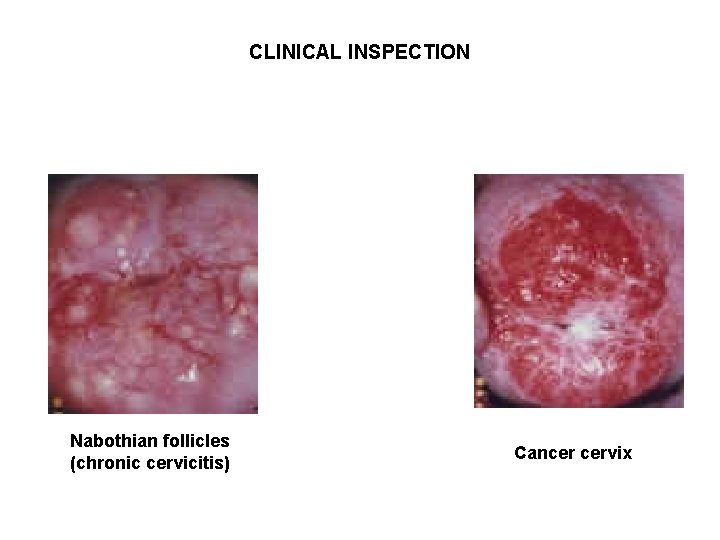 CLINICAL INSPECTION Nabothian follicles (chronic cervicitis) Cancer cervix 