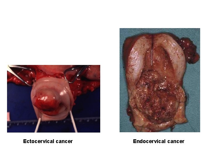 Ectocervical cancer Endocervical cancer 