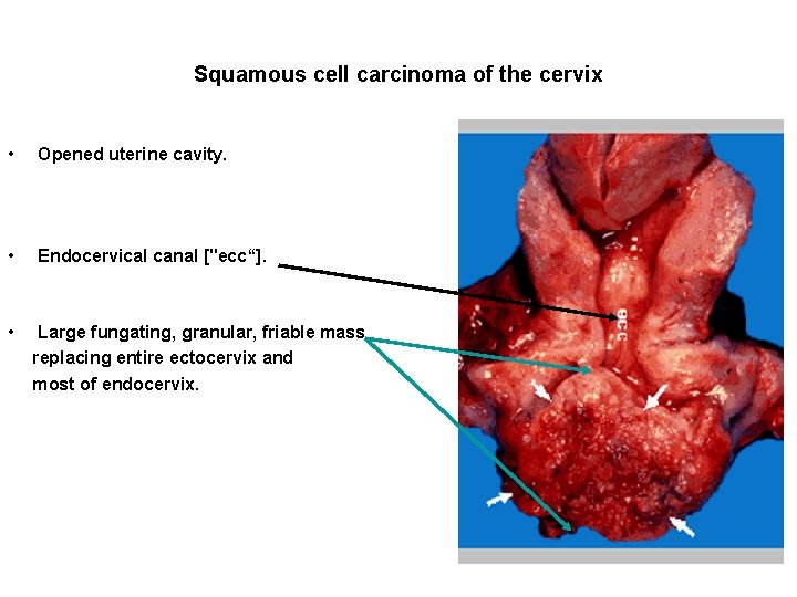 Squamous cell carcinoma of the cervix • Opened uterine cavity. • Endocervical canal ["ecc“].