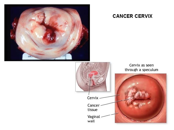 CANCER CERVIX 