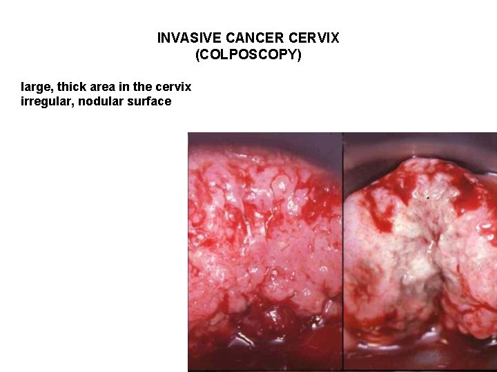 INVASIVE CANCER CERVIX (COLPOSCOPY) large, thick area in the cervix irregular, nodular surface 