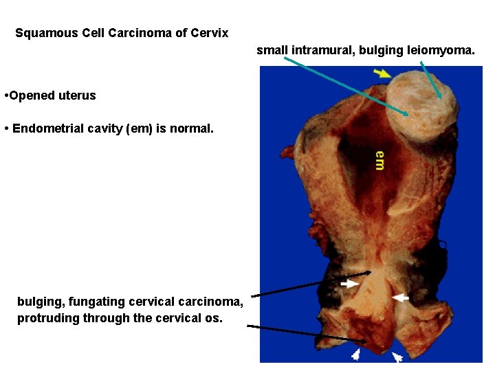 Squamous Cell Carcinoma of Cervix small intramural, bulging leiomyoma. • Opened uterus • Endometrial