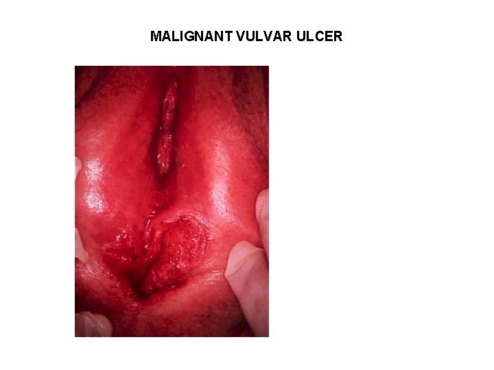 MALIGNANT VULVAR ULCER 