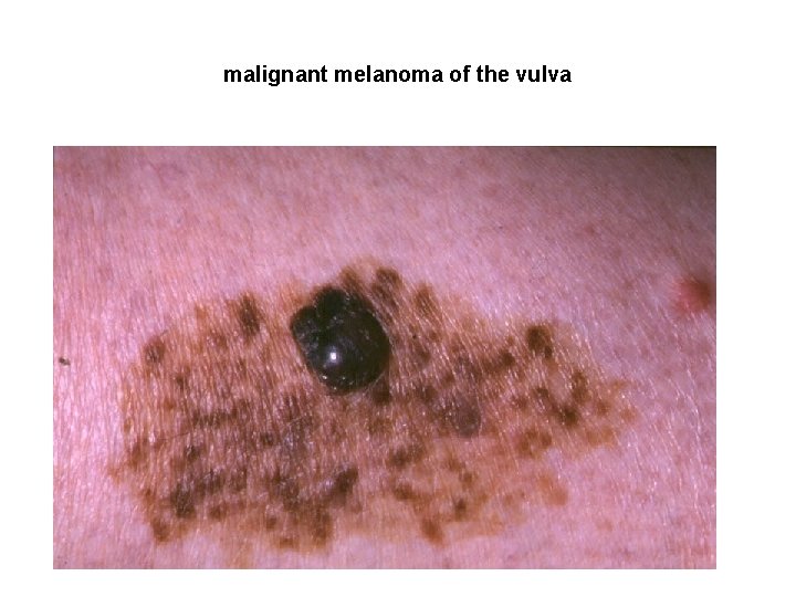 malignant melanoma of the vulva 