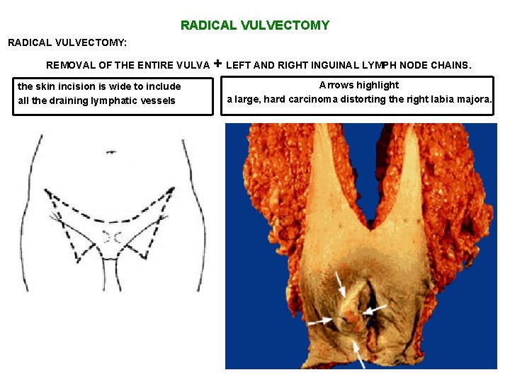 RADICAL VULVECTOMY: REMOVAL OF THE ENTIRE VULVA the skin incision is wide to include