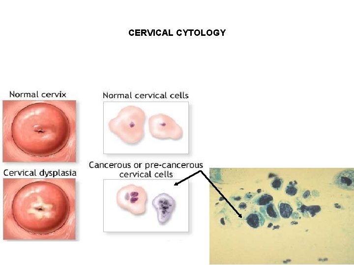 CERVICAL CYTOLOGY 