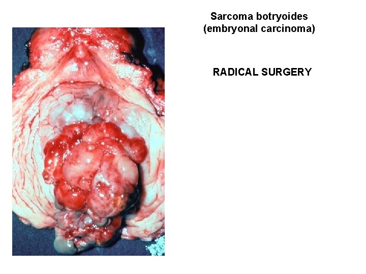 Sarcoma botryoides (embryonal carcinoma) RADICAL SURGERY 
