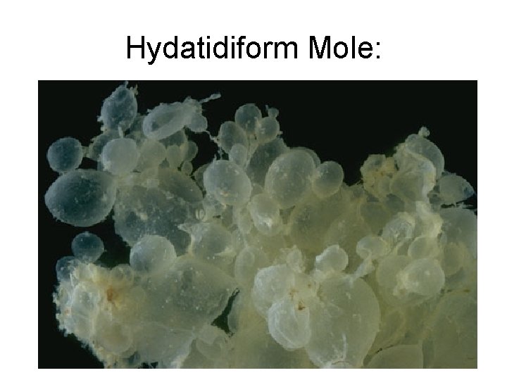 Hydatidiform Mole: 