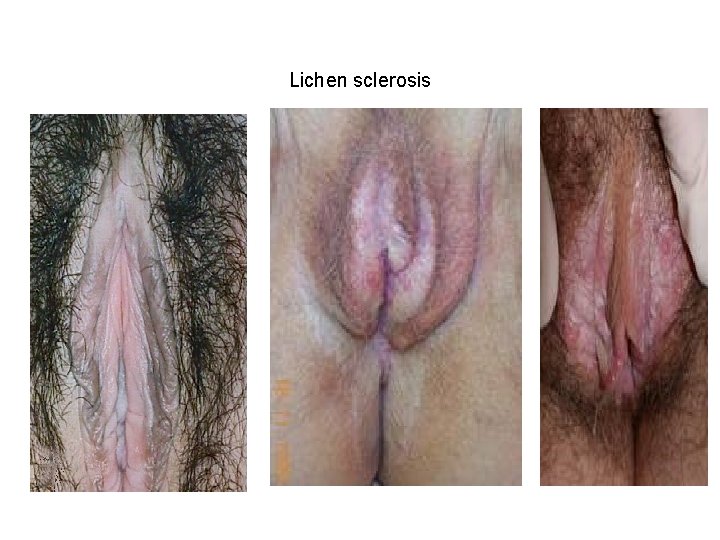 Lichen sclerosis 