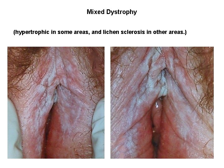 Mixed Dystrophy (hypertrophic in some areas, and lichen sclerosis in other areas. ) 