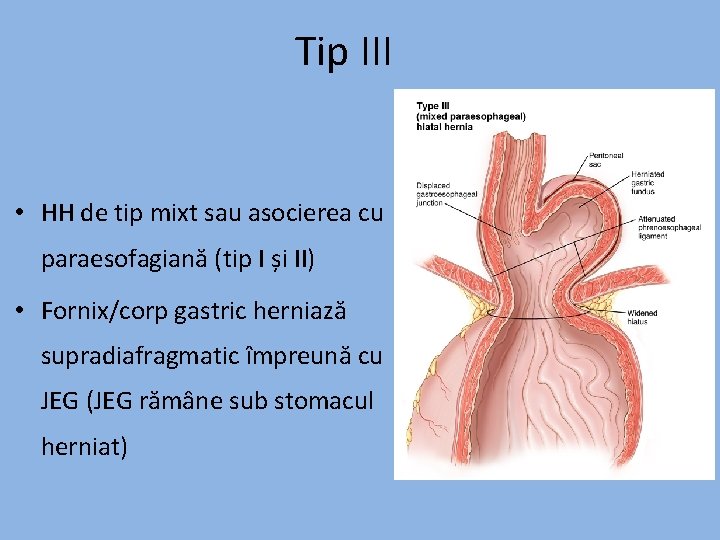 Tip III • HH de tip mixt sau asocierea cu paraesofagiană (tip I și