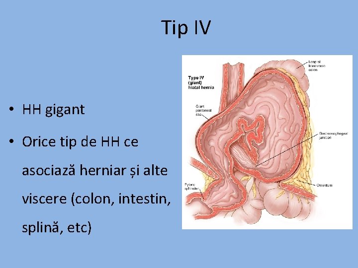 Tip IV • HH gigant • Orice tip de HH ce asociază herniar și