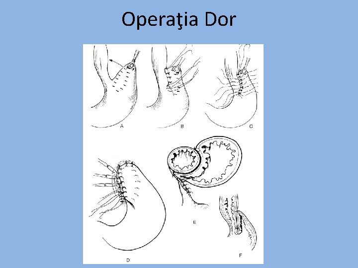 Operaţia Dor 