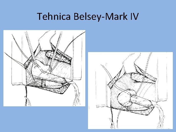 Tehnica Belsey-Mark IV 