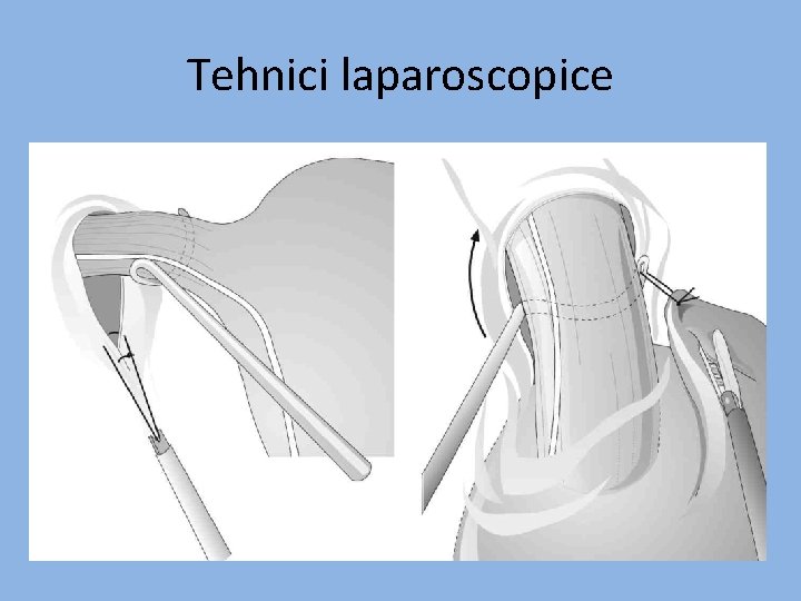 Tehnici laparoscopice 