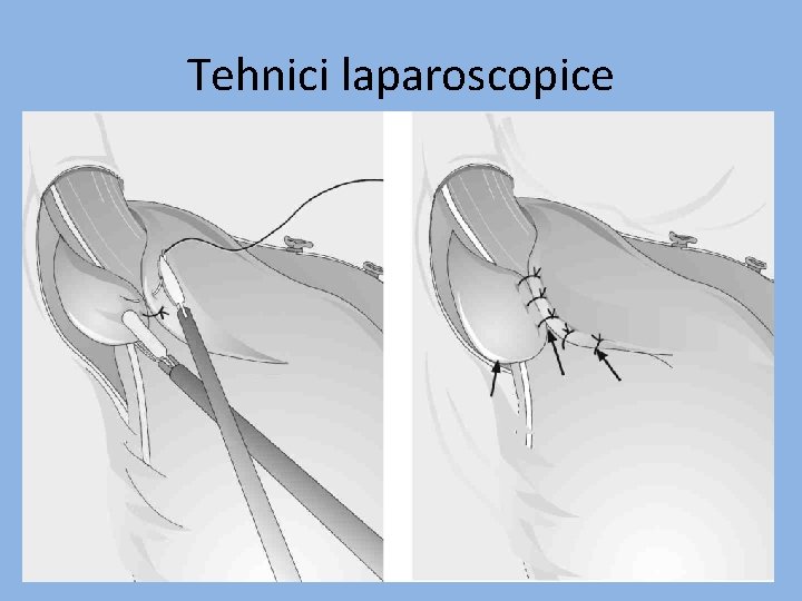 Tehnici laparoscopice 
