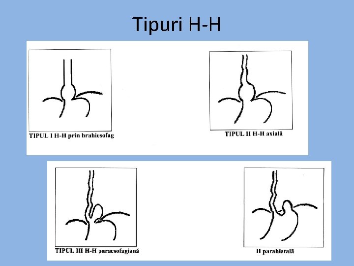 Tipuri H-H 